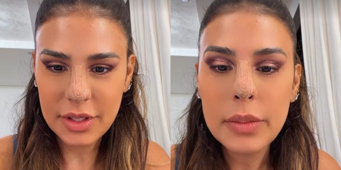 Simone Mendes explica recuperação da rinoplastia e brinca sobre envelhecimento aos 42 anos
