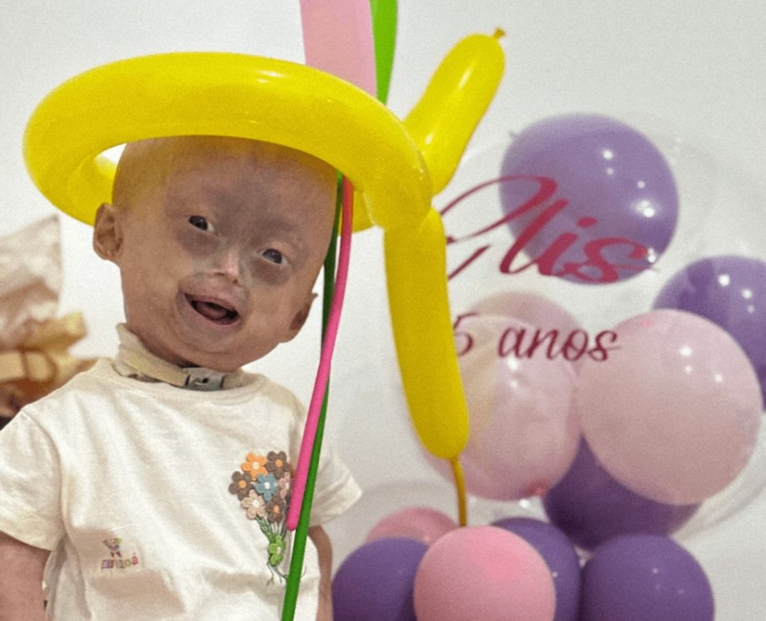 Elis Lima Carneiro, gêmea diagnosticada com progéria, morre aos 5 anos em Boa Vista