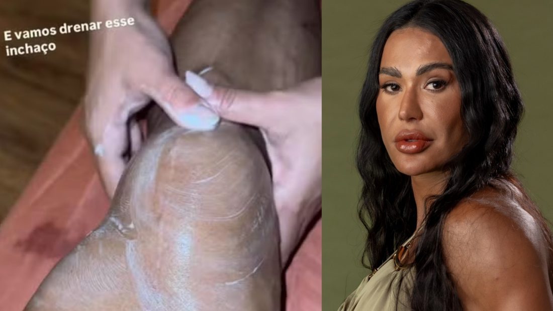 Joelho inchado de Gracyanne Barbosa levanta dúvida: quando o inchaço após exercício merece atenção?