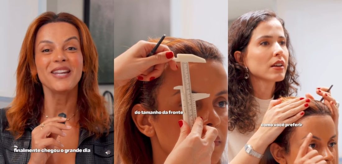 Gabriela Loran revela transplante capilar e conta insegurança com as entradas na testa