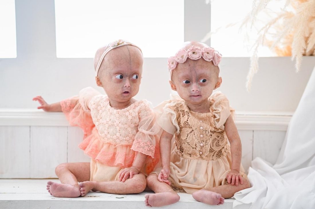 Mãe de gêmeas com progéria presta homenagem à filha de 5 anos que faleceu em Boa Vista