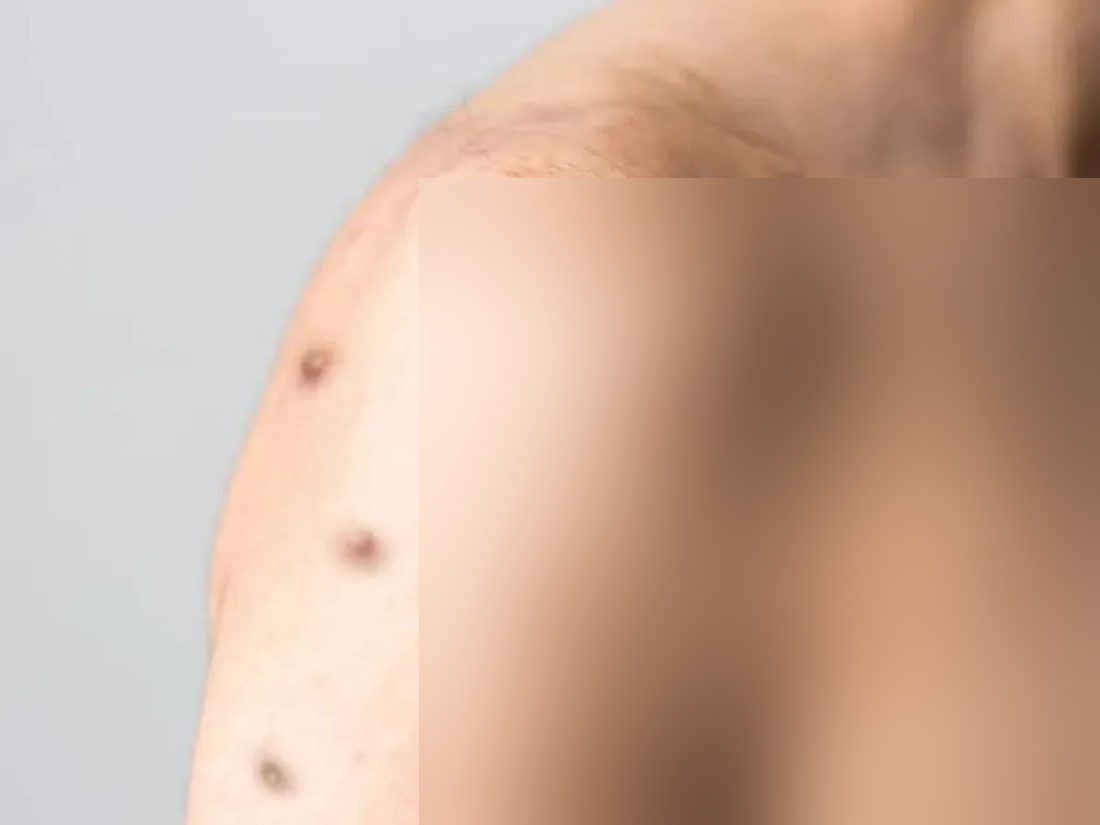 Casos de Mpox disparam 7 vezes no Rio em dois meses e capital está sem vacina