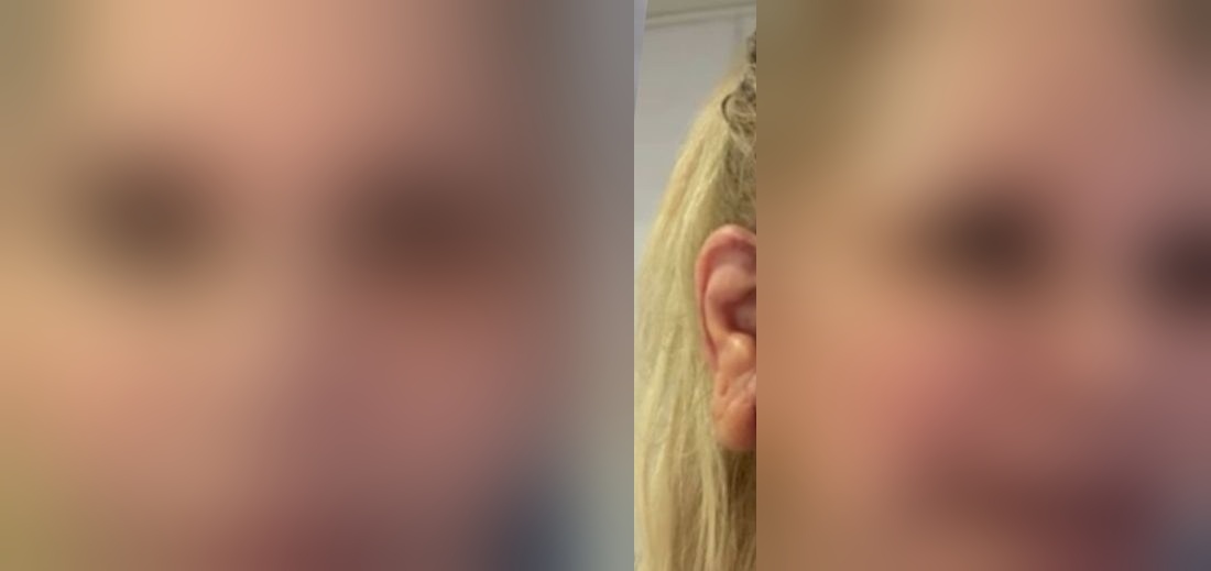 Monique Evans se Surpreendeu com Tranquilidade em Minilifting Facial... Mas agora fez Cirurgia Plástica
