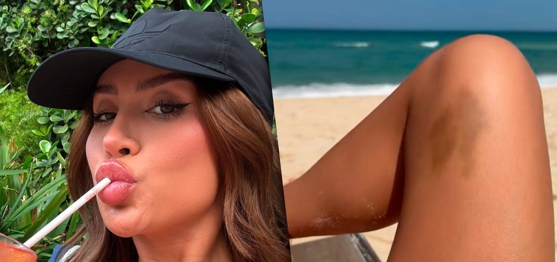 Bianca Andrade exibe hematoma roxo na perna durante dia de praia e brinca sobre Dança dos Famosos