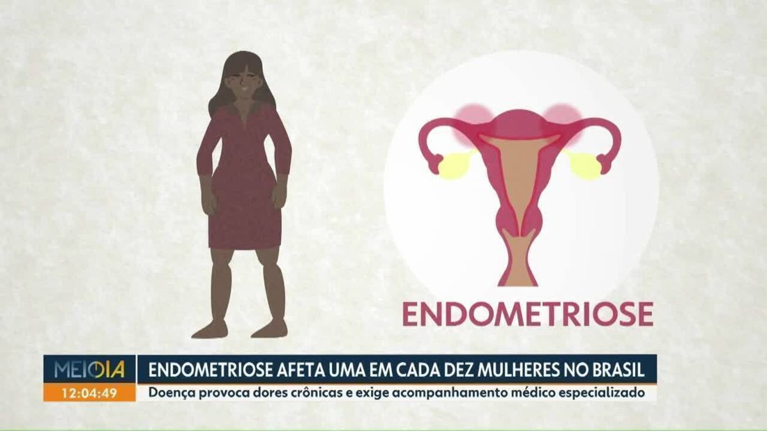 Planos de saúde passam a cobrir DIU hormonal no tratamento da endometriose
